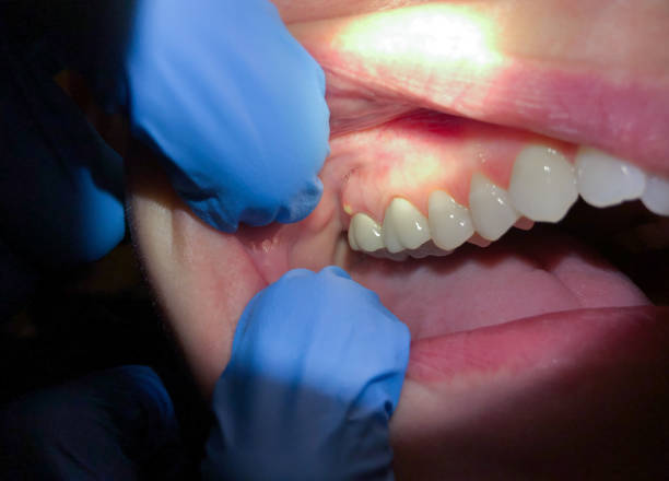 Best Emergency Dental Extractions in Grafton, WV